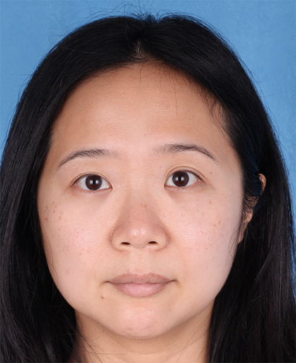 Lower Blepharoplasty Before & After Patient #524