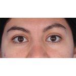 Ptosis Repair Before & After Patient #619