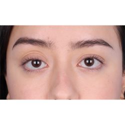 Ptosis Repair Before & After Patient #620