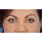Ptosis Repair Before & After Patient #621