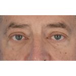 Ptosis Repair Before & After Patient #618