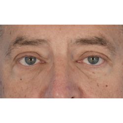 Ptosis Repair Before & After Patient #618