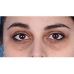 Lesion Removal Before & After Patient #360