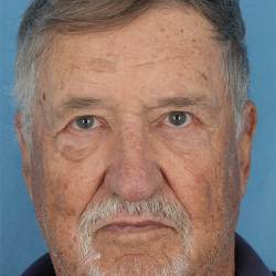 Ptosis Repair Before & After Patient #622