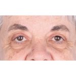 Ptosis Repair Before & After Patient #626