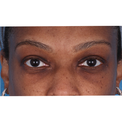 Upper Blepharoplasty Before & After Patient #693