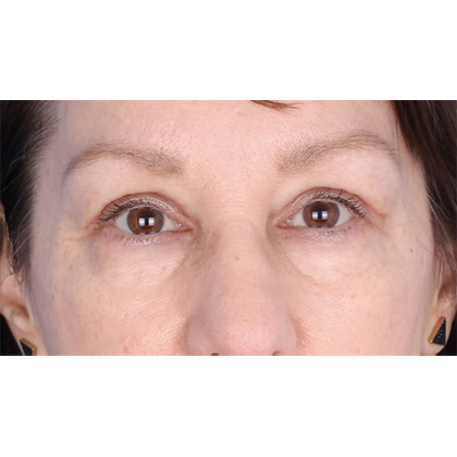 Upper Blepharoplasty Before & After Patient #695