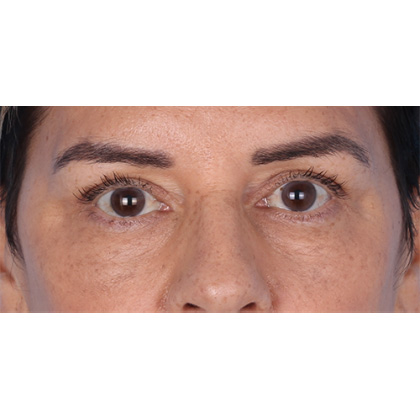 Upper Blepharoplasty Before & After Patient #696