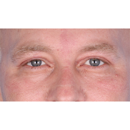 Upper Blepharoplasty Before & After Patient #697