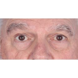 Lesion Removal Before & After Patient #357