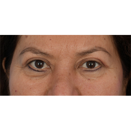 Upper Blepharoplasty Before & After Patient #701