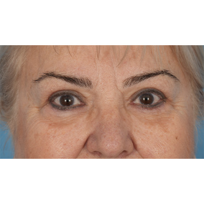 Upper Blepharoplasty Before & After Patient #702