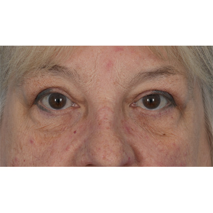 Upper Blepharoplasty Before & After Patient #728