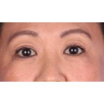 Double Eyelid Surgery Before & After Patient #339