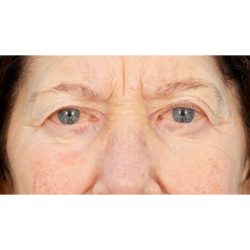 Tepezza Before & After Patient #829