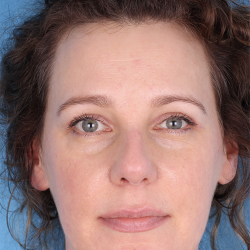 Upper Blepharoplasty Before & After Patient #692