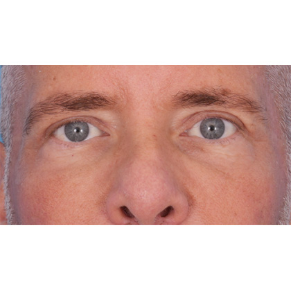 Upper Blepharoplasty Before & After Patient #699