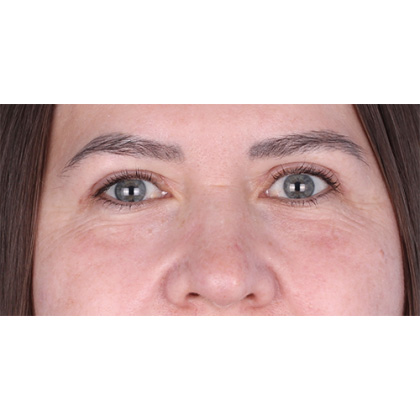 Upper Blepharoplasty Before & After Patient #698