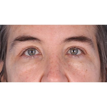 Upper Blepharoplasty Before & After Patient #813