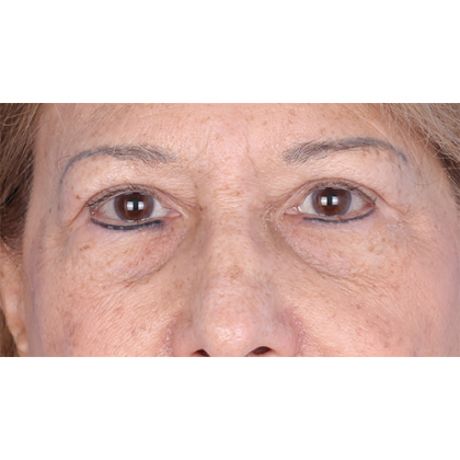 Upper Blepharoplasty Before & After Patient #814