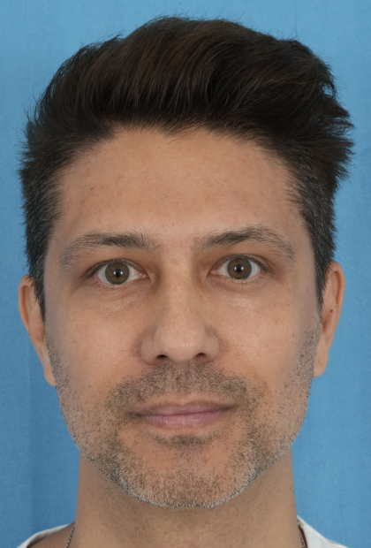 Lower Blepharoplasty Before & After Patient #527