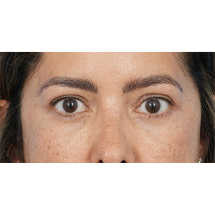 Four Lid Blepharoplasty Before & After Patient #397