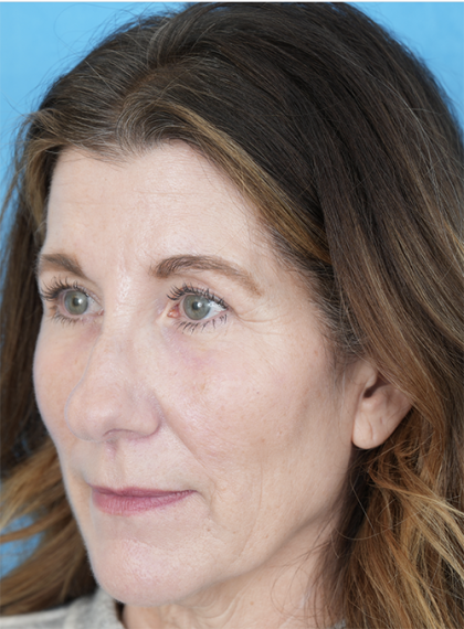 Lower Blepharoplasty Before & After Patient #525