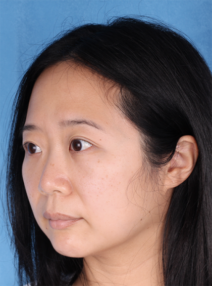 Lower Blepharoplasty Before & After Patient #524