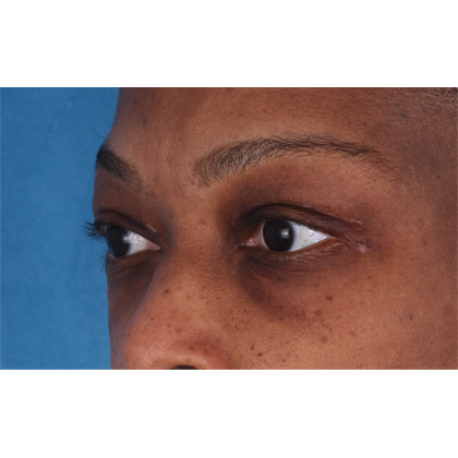 Upper Blepharoplasty Before & After Patient #693
