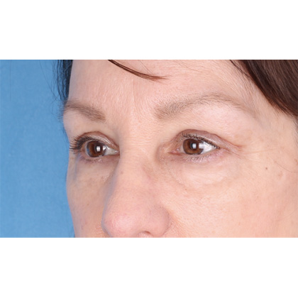 Upper Blepharoplasty Before & After Patient #695