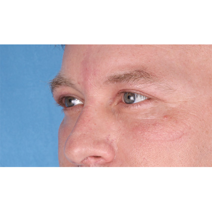 Upper Blepharoplasty Before & After Patient #697