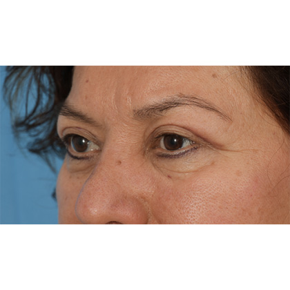 Upper Blepharoplasty Before & After Patient #701