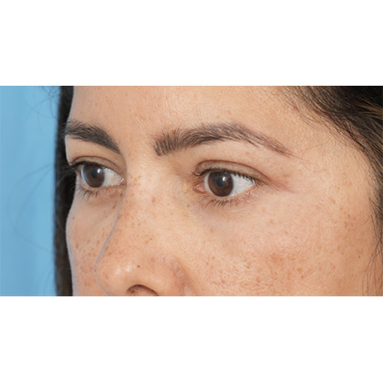 Four Lid Blepharoplasty Before & After Patient #397