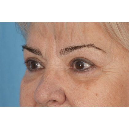 Upper Blepharoplasty Before & After Patient #702