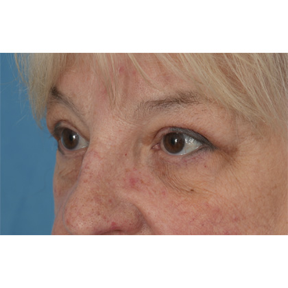 Upper Blepharoplasty Before & After Patient #728