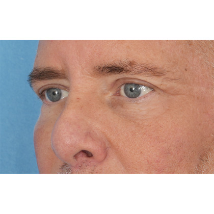Upper Blepharoplasty Before & After Patient #699