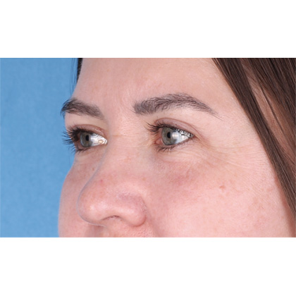 Upper Blepharoplasty Before & After Patient #698