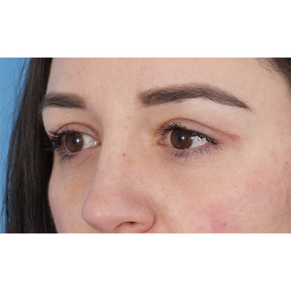 Upper Blepharoplasty Before & After Patient #700