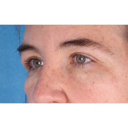 Upper Blepharoplasty Before & After Patient #813