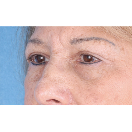 Upper Blepharoplasty Before & After Patient #814