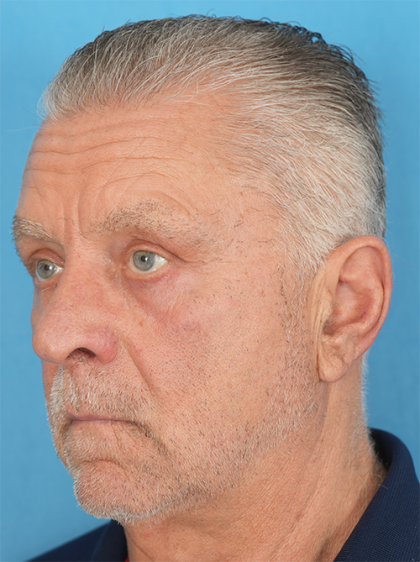 Four Lid Blepharoplasty Before & After Patient #396