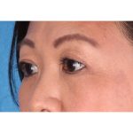 Double Eyelid Surgery Before & After Patient #339
