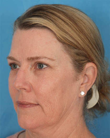 Four Lid Blepharoplasty Before & After Patient #394