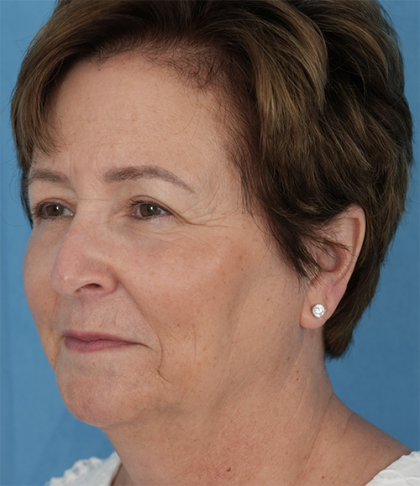 Four Lid Blepharoplasty Before & After Patient #401