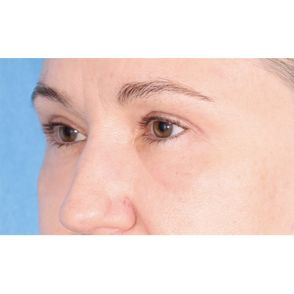 Four Lid Blepharoplasty Before & After Patient #399