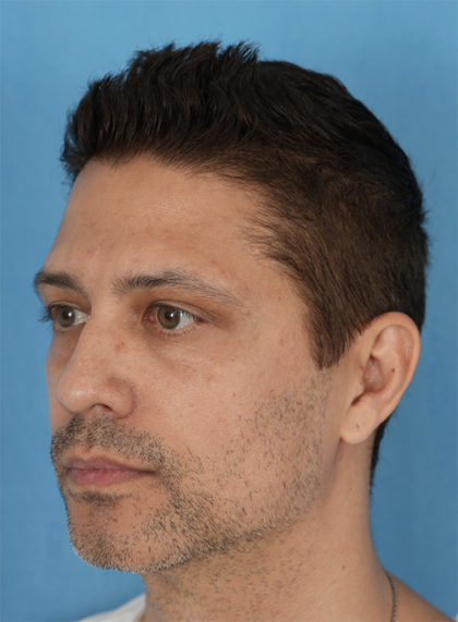Lower Blepharoplasty Before & After Patient #527