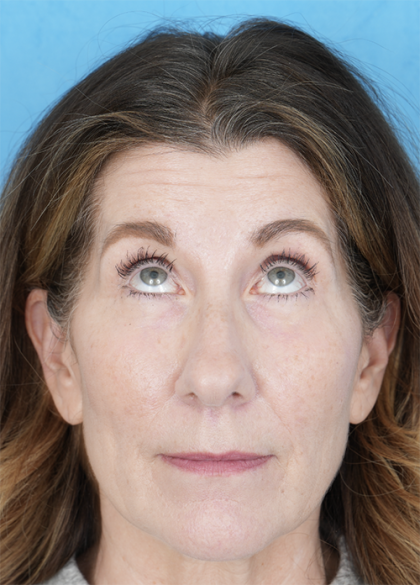 Lower Blepharoplasty Before & After Patient #525