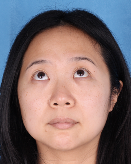 Lower Blepharoplasty Before & After Patient #524