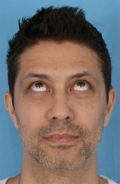 Lower Blepharoplasty Before & After Patient #527