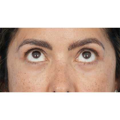 Four Lid Blepharoplasty Before & After Patient #397
